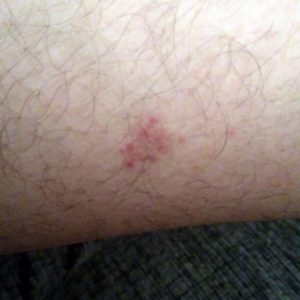 Mancha Roja En La Pierna Dermatologo Net