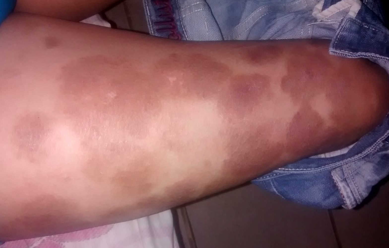 Manchas Oscuras En Las Piernas Que Pican Dermatologo Net