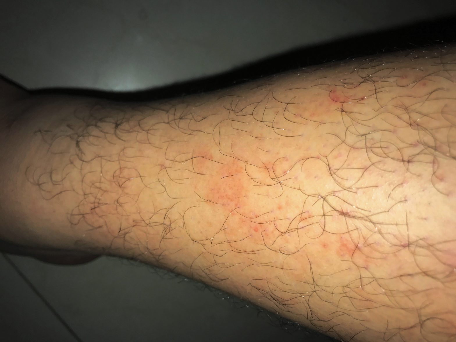 Manchas En Las Piernas Desde Hace Un Mes Dermatologo Net