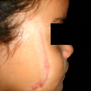 Cicatriz facial infantil