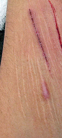 Cicatriz