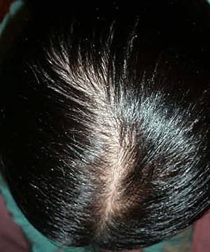 Dermatitis seborreica de cuero cabelludo