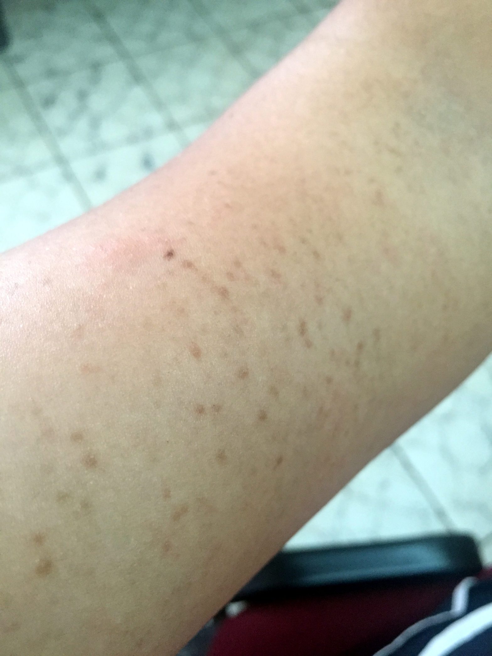 Manchas oscuras y bruscas en los brazos – dermatologo.net