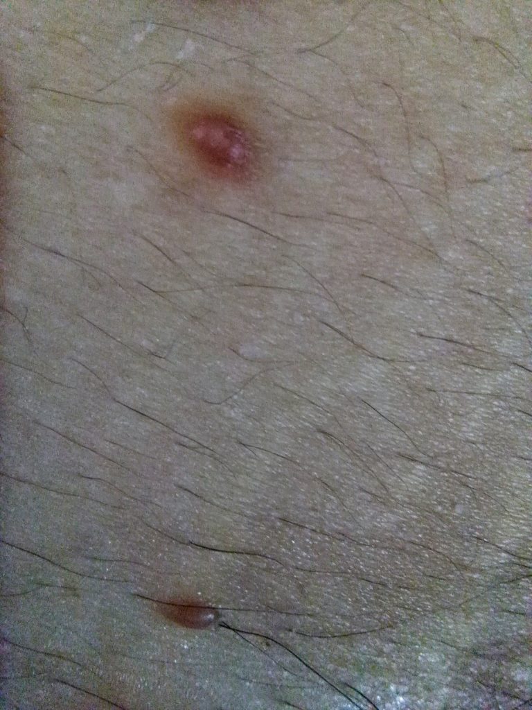 infección cutánea – Página 20 – dermatologo.net