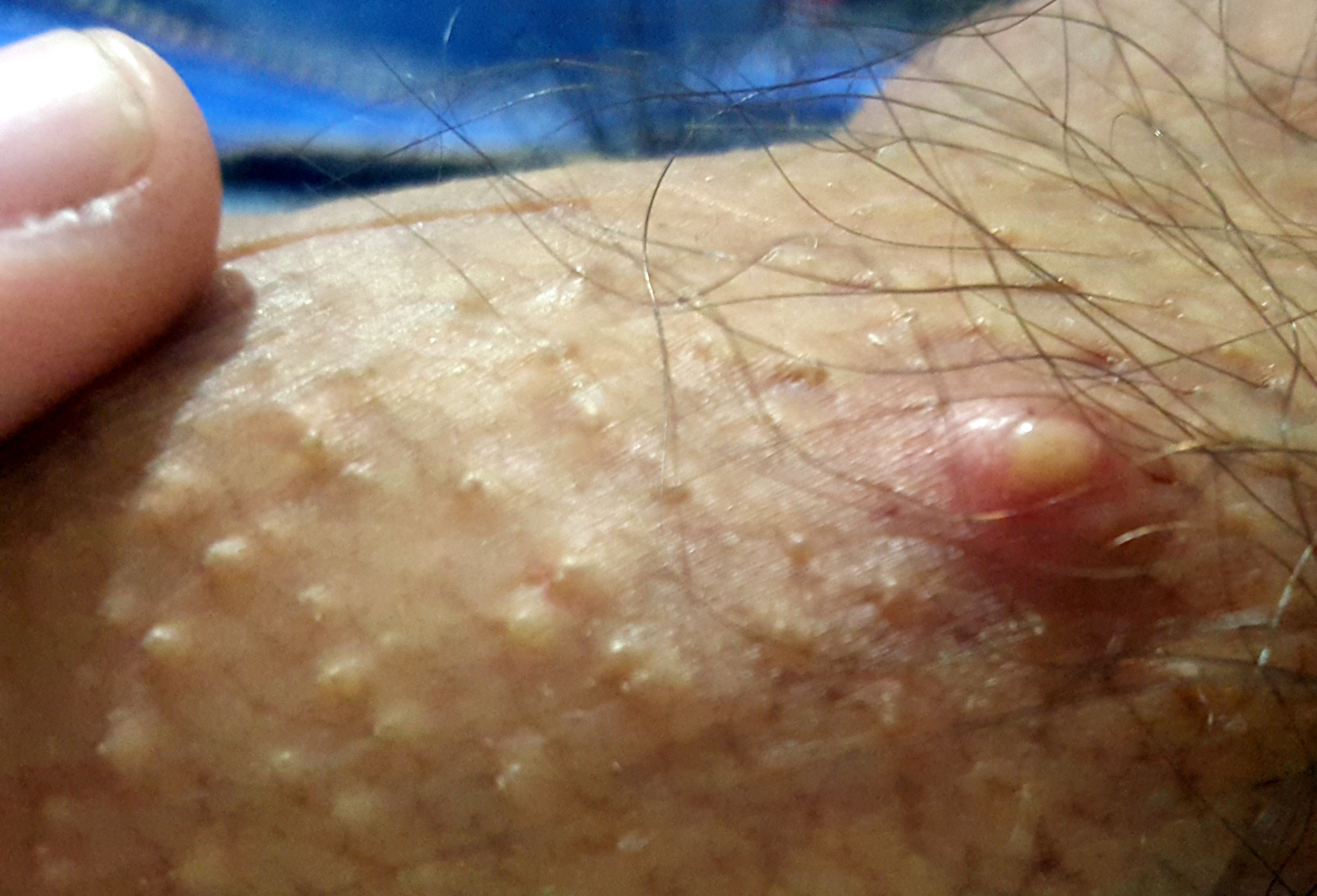 Fotos de petequias en la piel