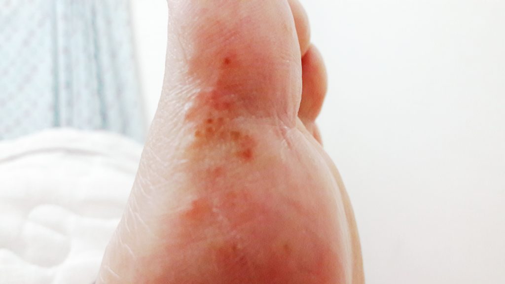 Granitos en el dedo gordo del pie. – dermatologo.net - Grano En La Planta Del Pie Que Duele
