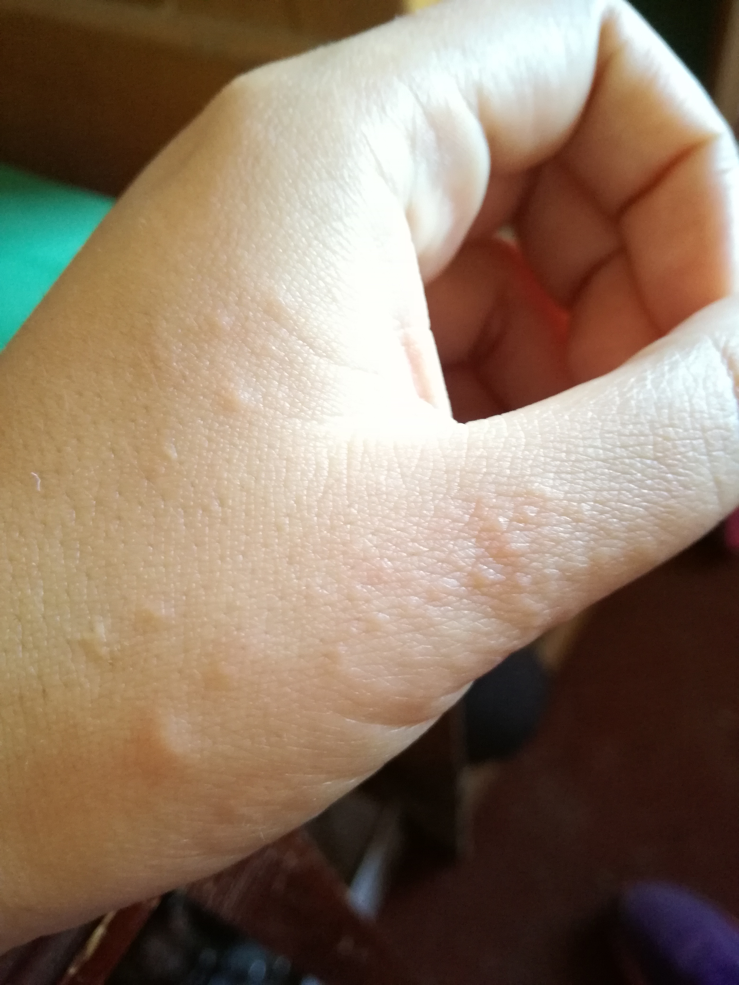 Granos en las manos picor hace pocos dias. – dermatologo.net