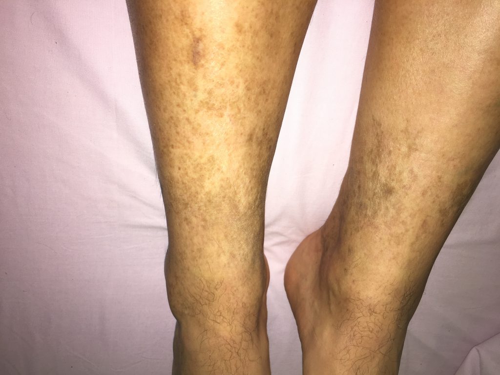 Hola Pogo stick jump Sur Manchas oscuras en piernas y tobillos – dermatologo.net