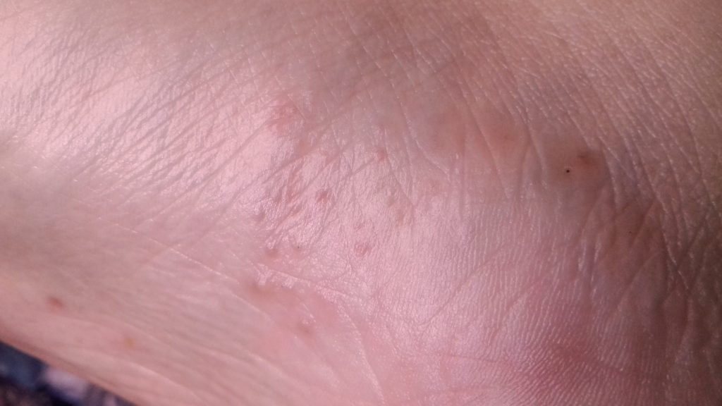Pequeños granitos que pican en la planta del pie. – dermatologo.net - Grano En La Planta Del Pie Que Duele