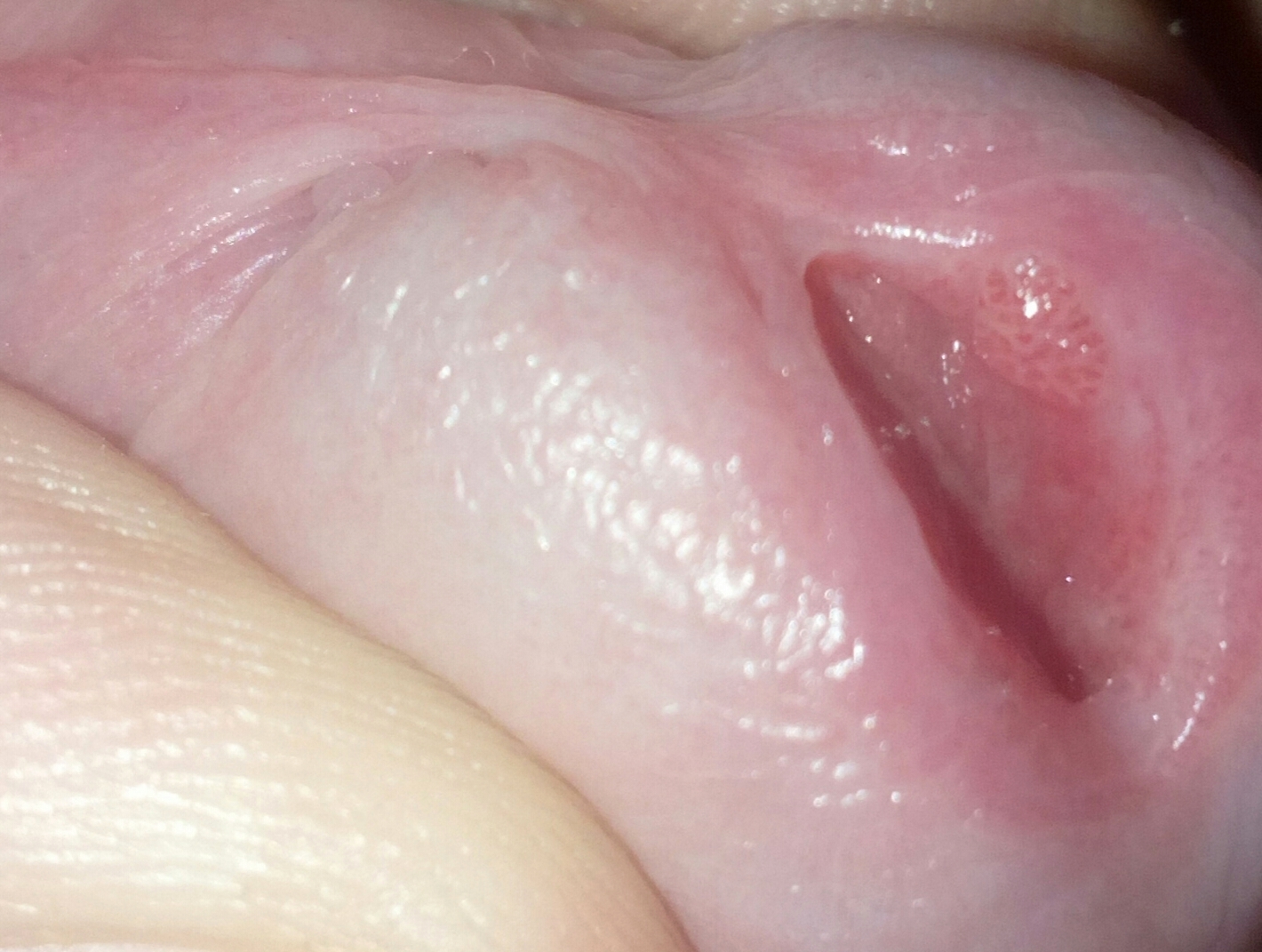 Bolitas blancas en la lengua