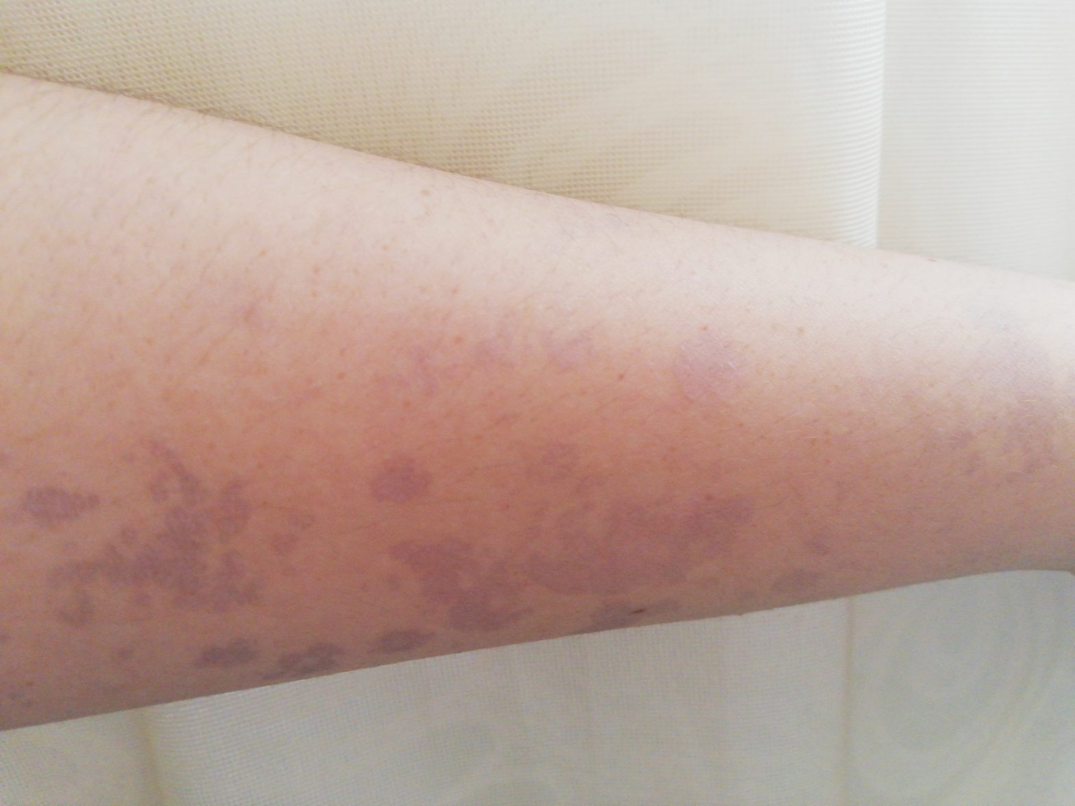 Manchas oscuras en los brazos de un dia para otro. – dermatologo.net