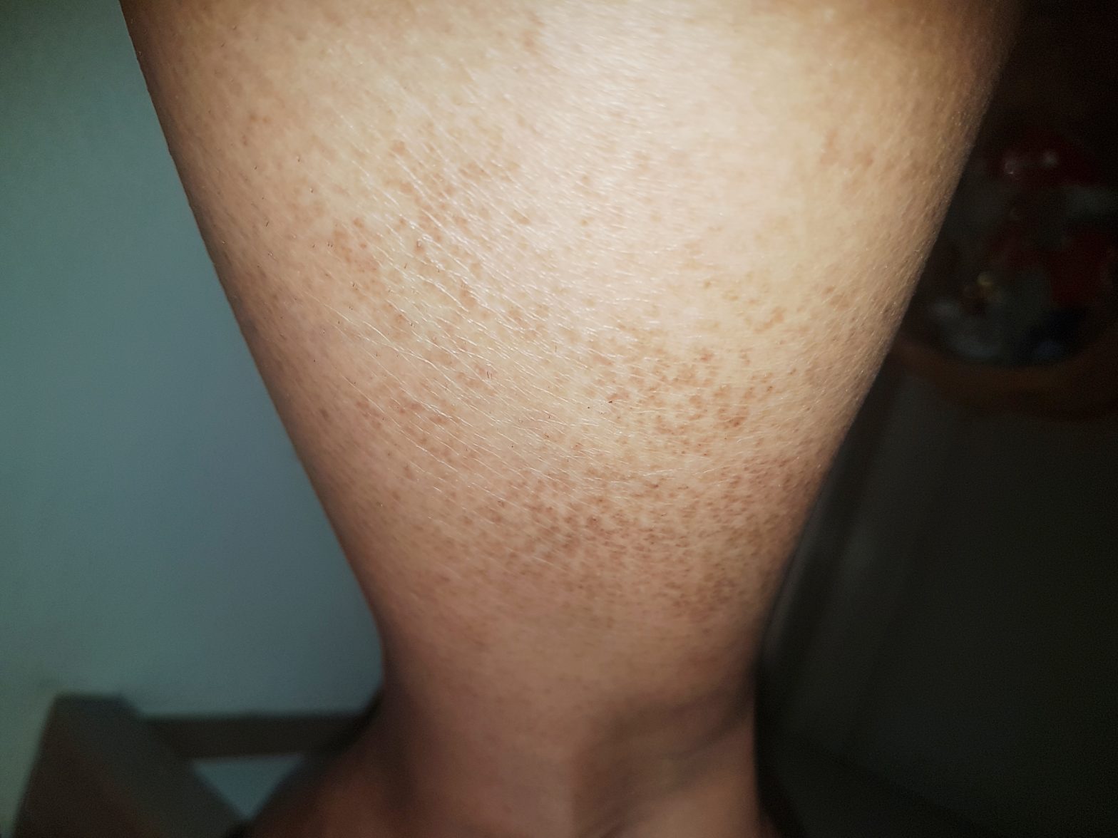 Manchas marrones en piernas, pies o brazos. – dermatologo.net