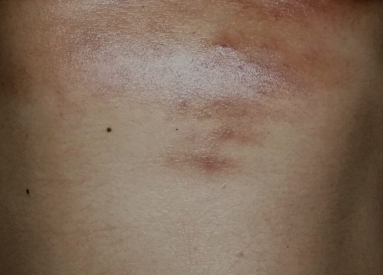 Me han salido manchas oscuras en el cuerpo. – dermatologo.net