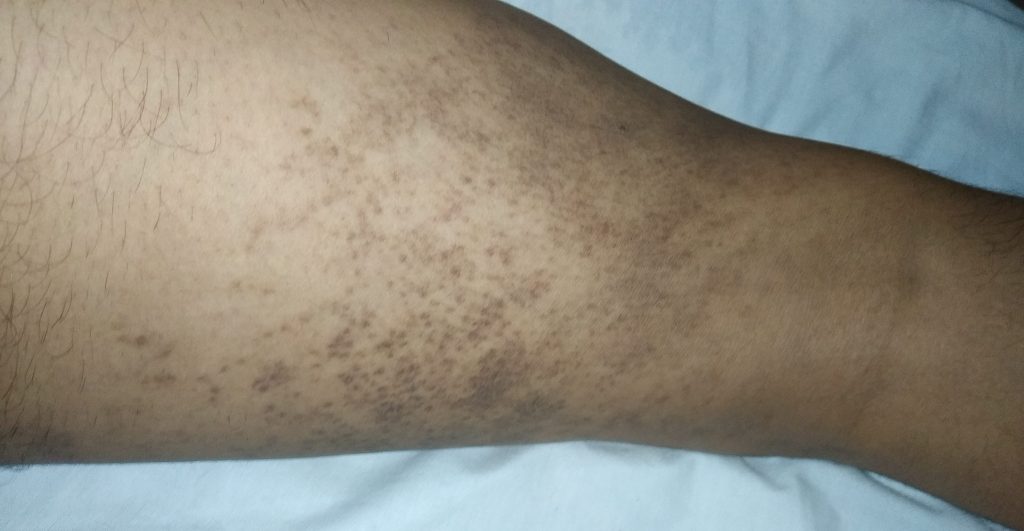 revisión Menagerry artería Manchas pruriginosas en las piernas, pies y manos. – dermatologo.net