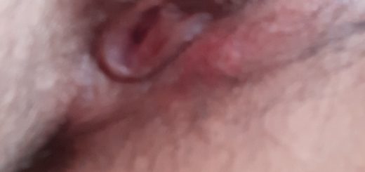 Abceso doloroso en labio vaginal