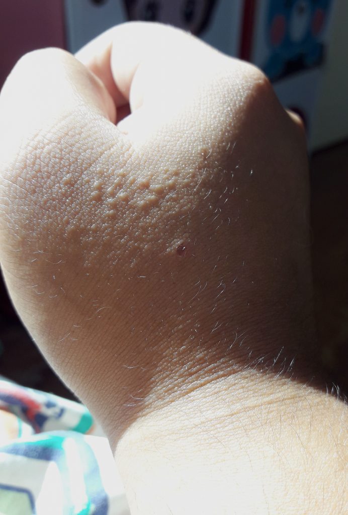 Granitos en aumento que afectan la mano – dermatologo.net