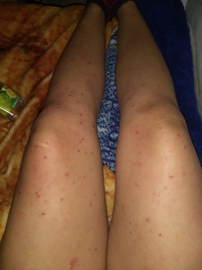 con líquido que pican en mis piernas – dermatologo.net